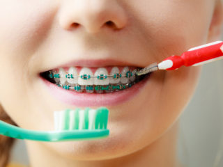 Living with braces Here are 5 things you need to take care of