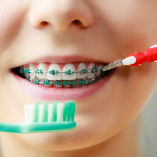 Living with braces Here are 5 things you need to take care of