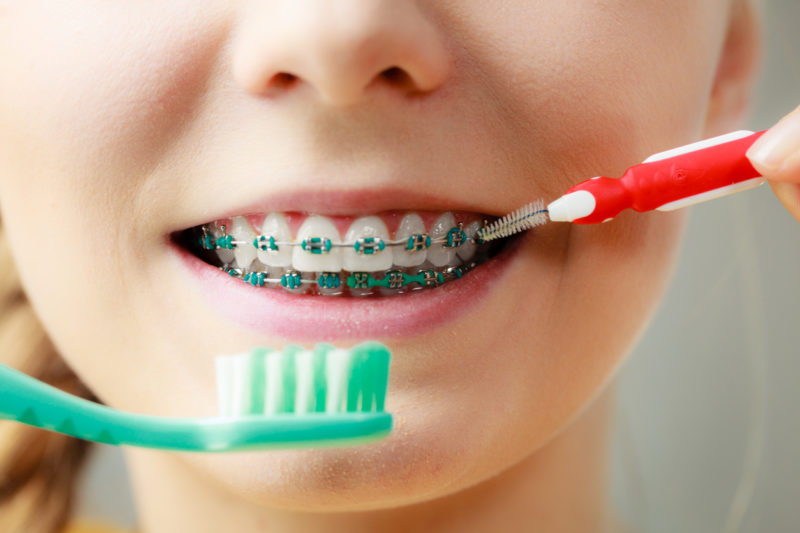 Living with braces Here are 5 things you need to take care of